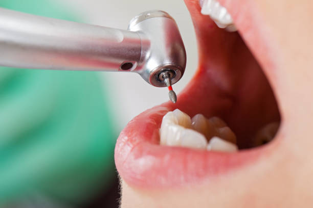 Emergency Dental Filling Replacement in LA